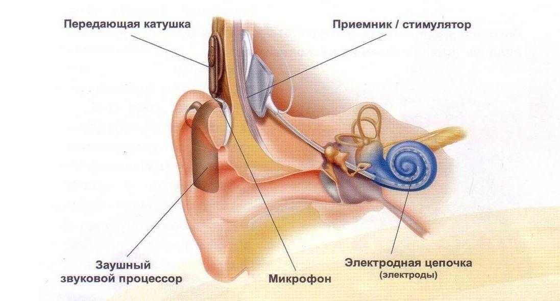 Слуховой аппарат внутреннего уха. Кохлеарный имплант внутренняя часть. Кохлеарная имплантация строение уха. Кохлеарный имплант слух. Кохлеарный имплант строение.